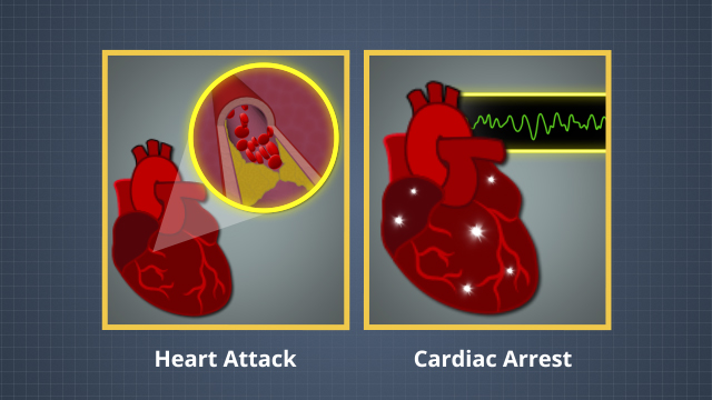 当血液在通往心脏的血管中流动受阻时，心脏病就会发作。当心脏的电气系统发生故障并导致心脏不规则地击打时，发生心脏骤停。