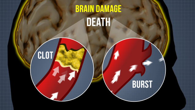 中风会很快造成严重的脑损伤。两种常见的原因是血栓和血管破裂。