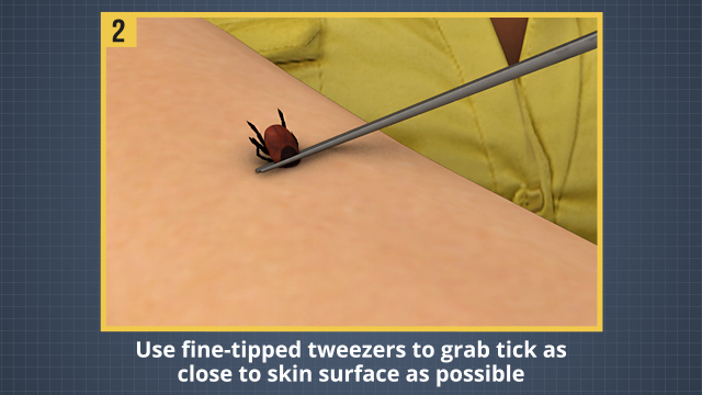 在穿过可能有蜱虫的区域后，最好检查一下自己的身体，如果你发现了蜱虫，用镊子把它拔掉。