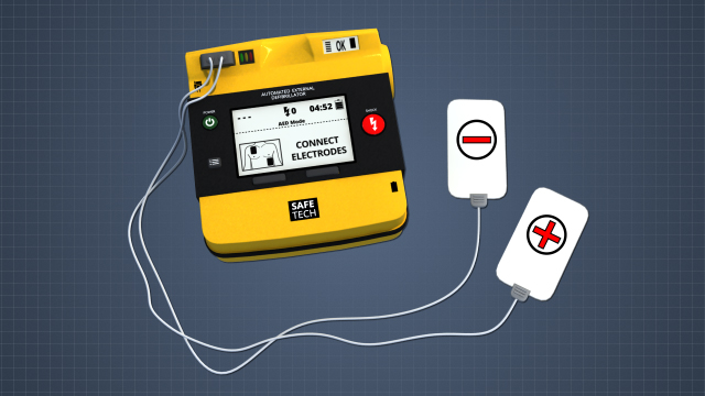 AED将包括主机，电缆和两个焊盘。一张垫是消极的，一个垫将是正面的。